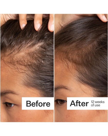Act + Acre Scalp Serum